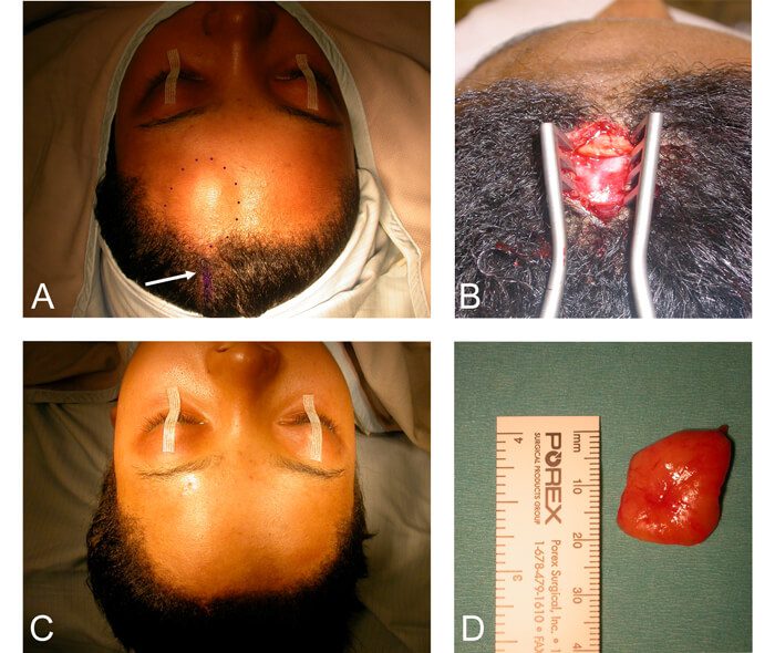 forehead-lipoma