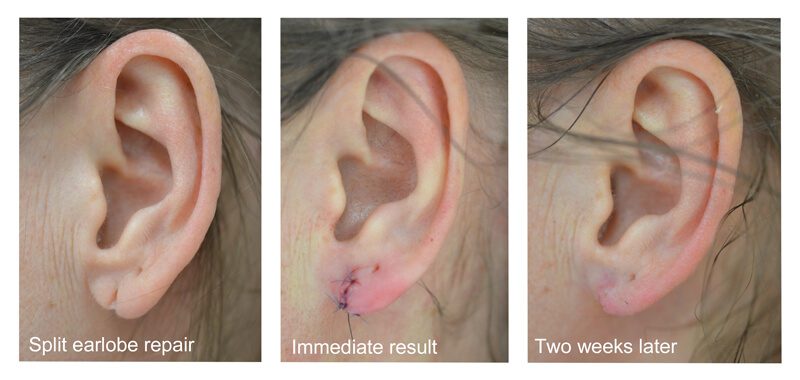 split-earlobe-2