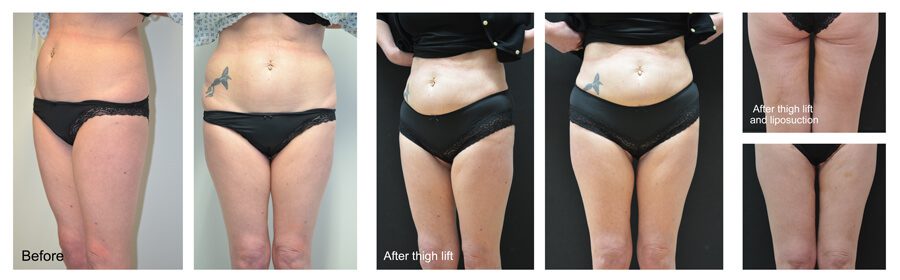 Thigh-lift-lipo_steph-edit