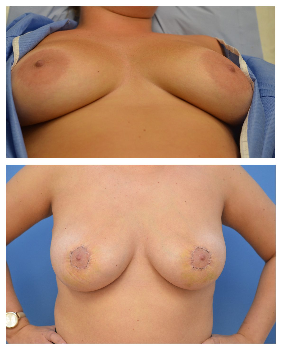 Areola-Montage-1