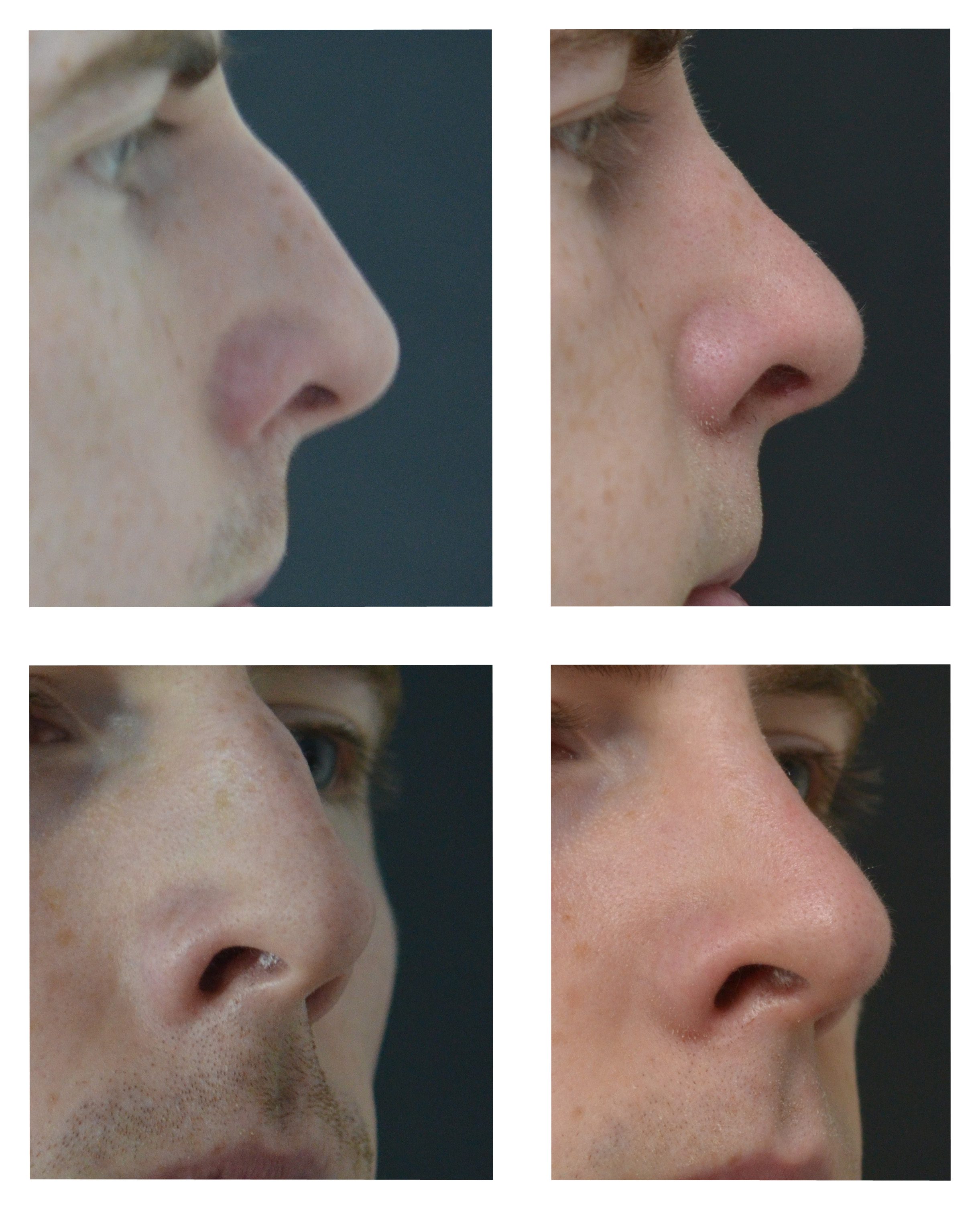 rhinoplasty