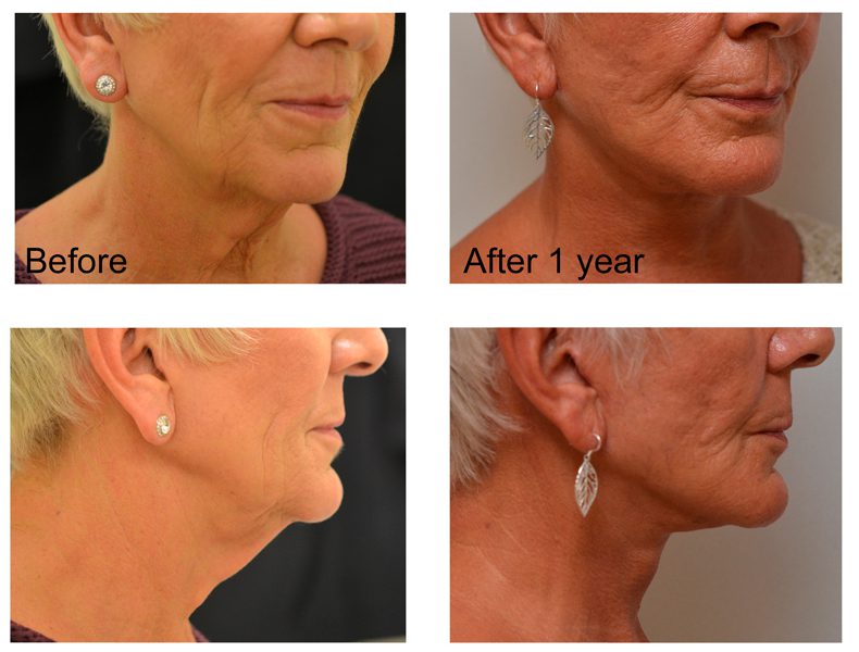 Neck-lift123