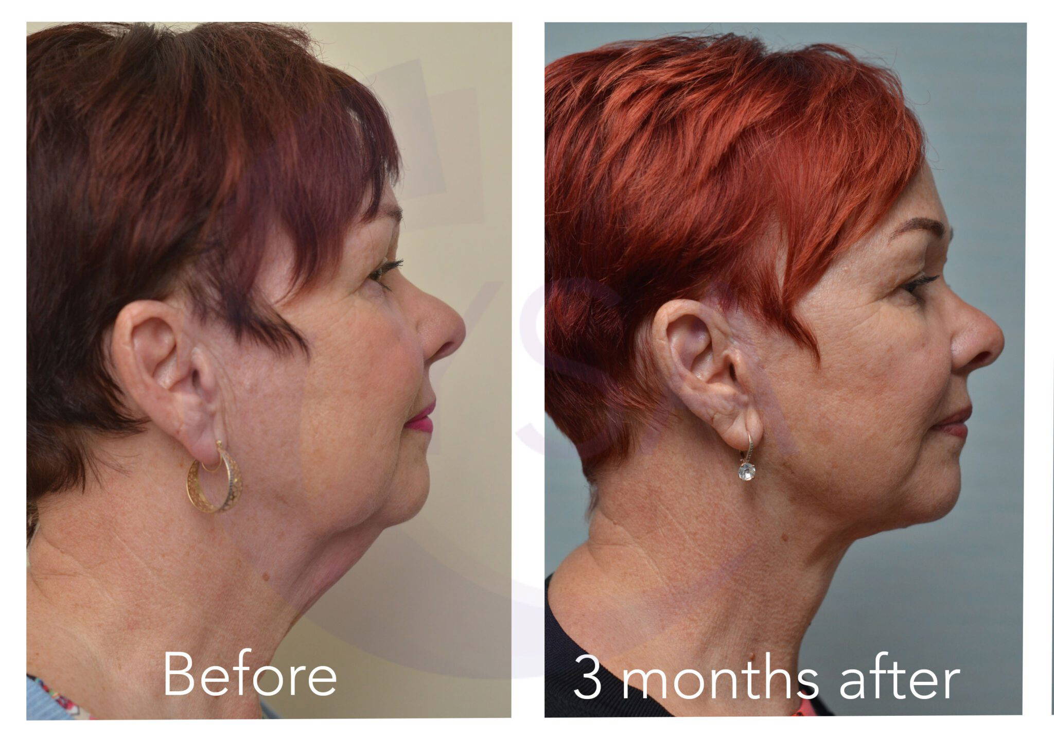 Neck-lift123