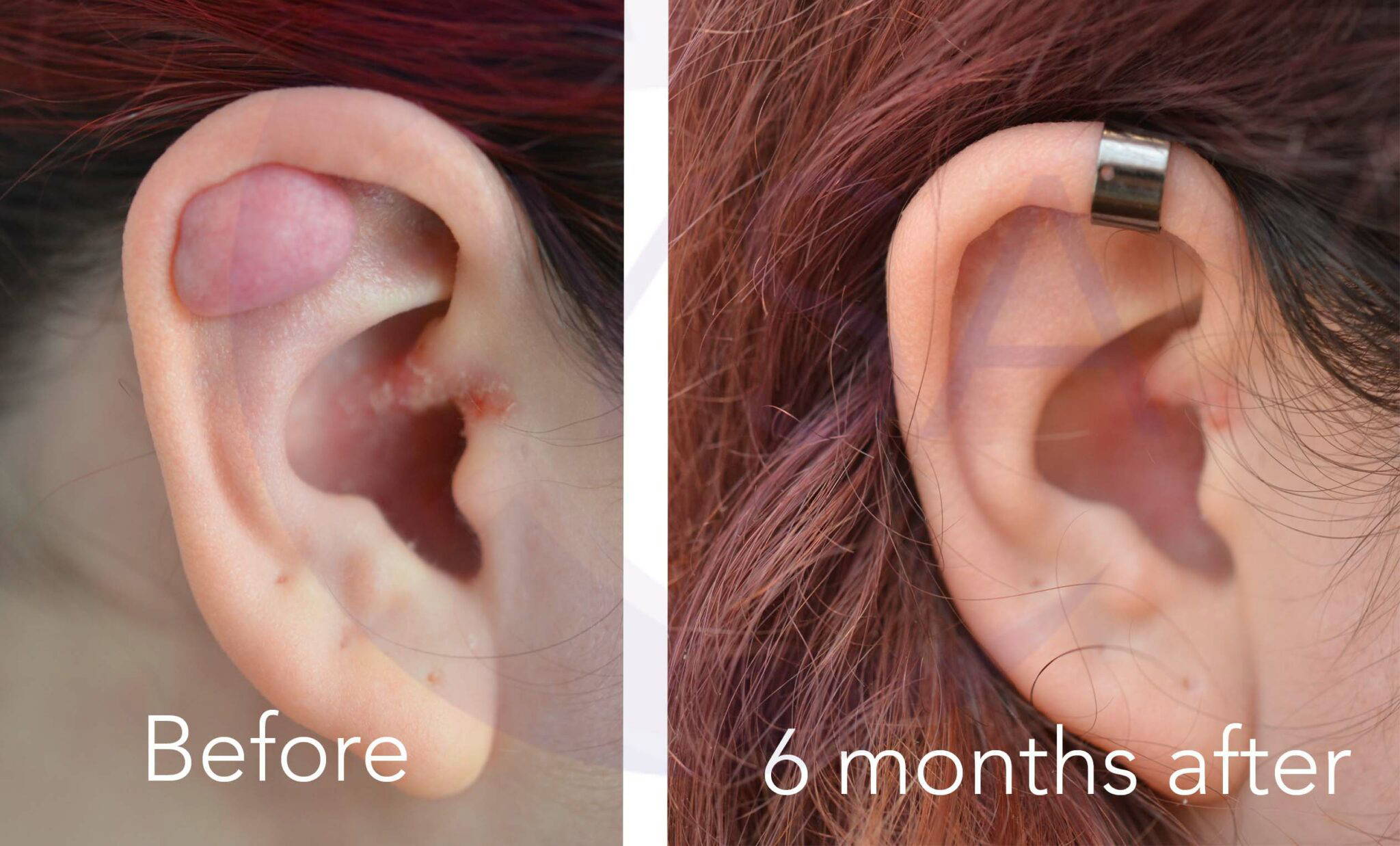 Keloid EAR NM TPC WEBSITE forehead-lipoma